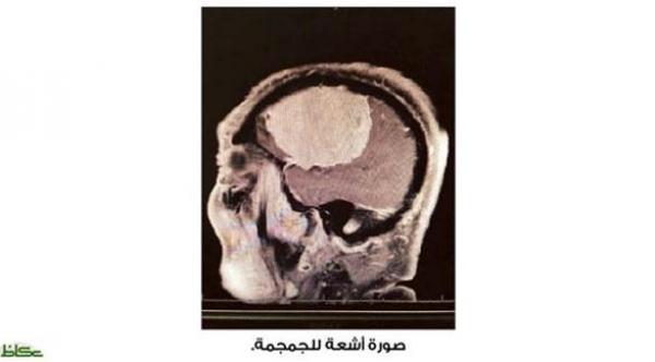 اسئصال ورم دماغي بطول 10 سنتم من جمجمة ثمانيني