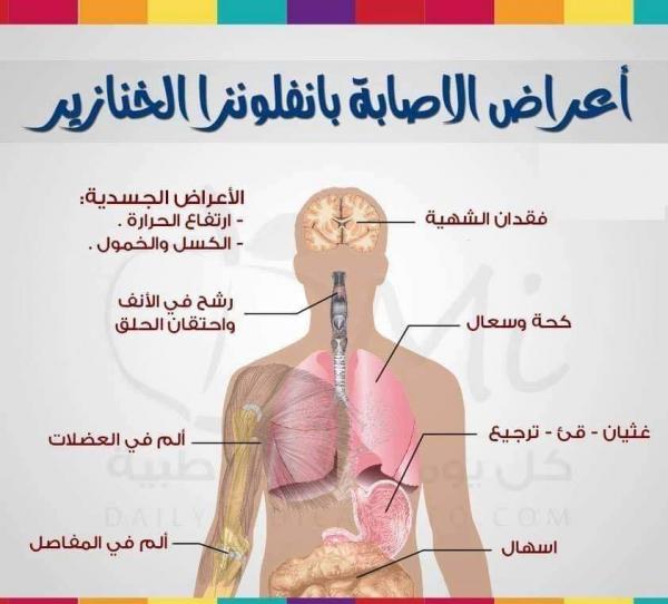 أعراض أنفلونزا الخنازير