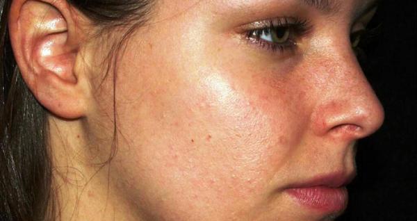 شاهد.. فيديو صادم يظهر تأثير الشمس على البشرة