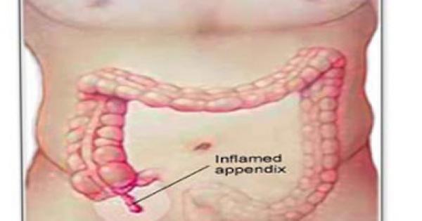 أعراض التهاب الزائدة الدودية