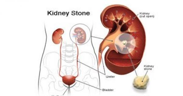 دراسة: حصوات الكلى ترفع فرص حدوث الفشل الكلوى مستقبلاً