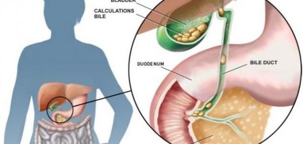 كيف تتشكل حصى المرارة ومتى يجب التدخل جراحيا؟