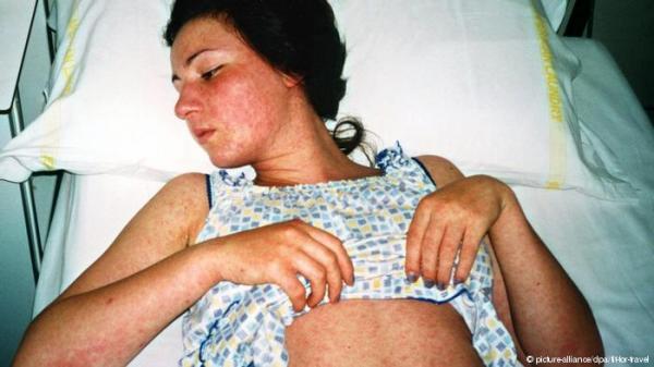 هل تقتل الحصبة؟ وما هي أهمية التطعيم ضدها؟