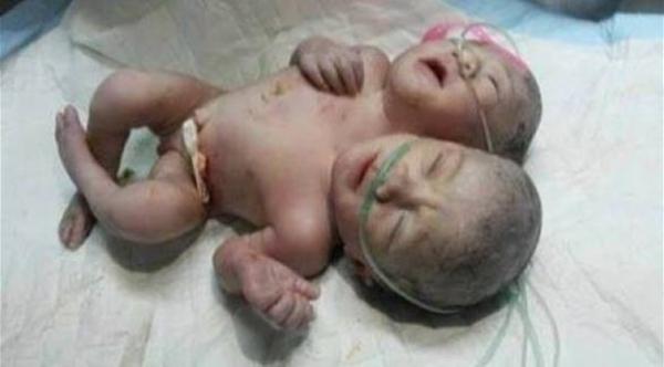 ولادة توأم سيامي بجسد واحد ورأسين في غزة