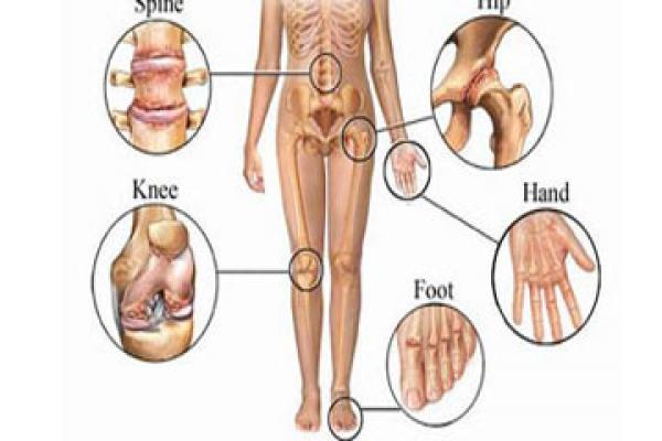 دراسة: الفراعنة استخدموا علاجا فعالا لعلاج الروماتيزم